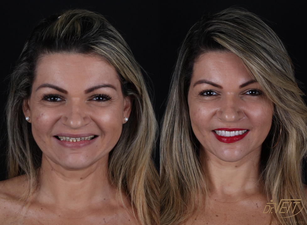 Antes e depois: caso real