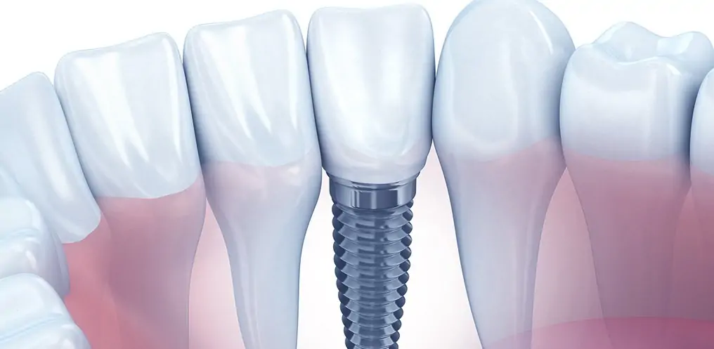 Implante Dentário