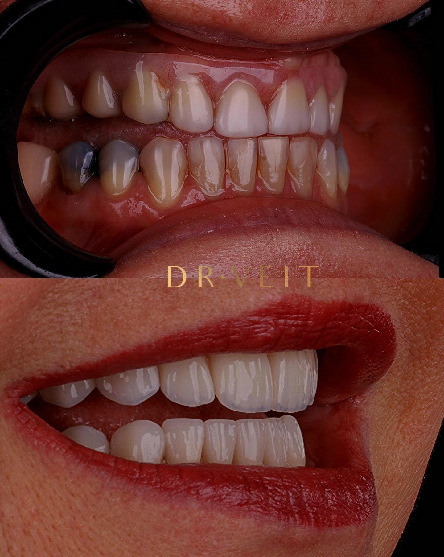 Implante Dentário