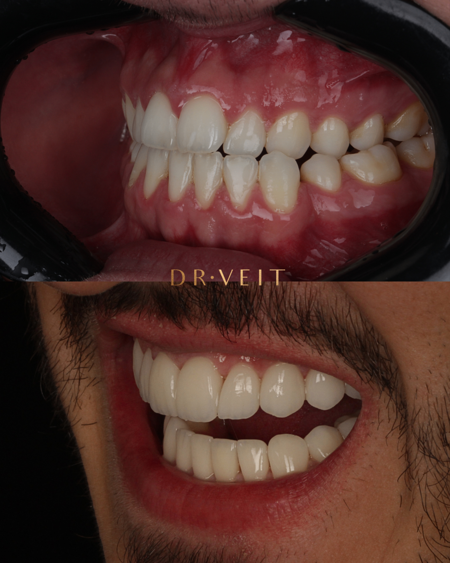 Invisalign