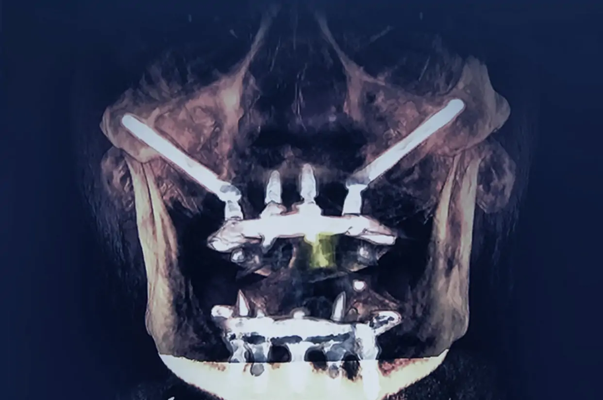 Implante Zigomático